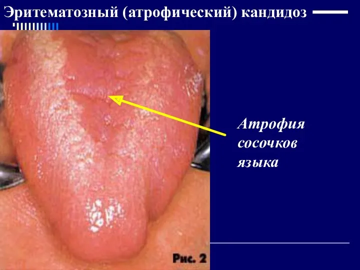 Эритематозный (атрофический) кандидоз Атрофия сосочков языка