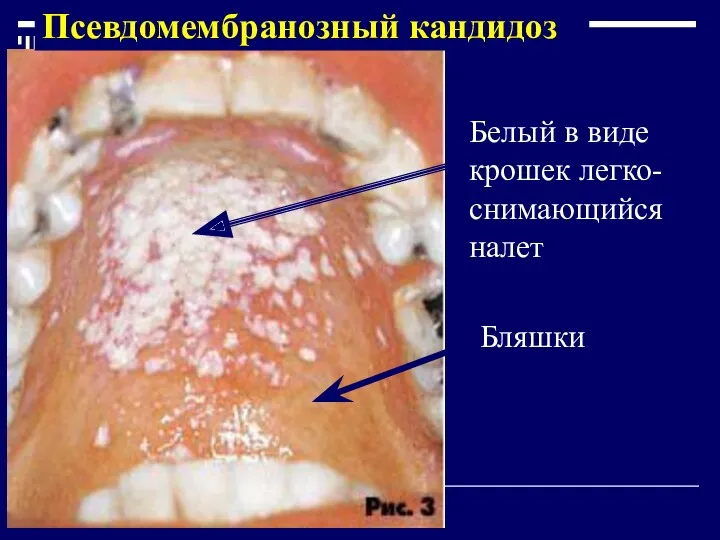 Псевдомембранозный кандидоз Белый в виде крошек легко-снимающийся налет Бляшки