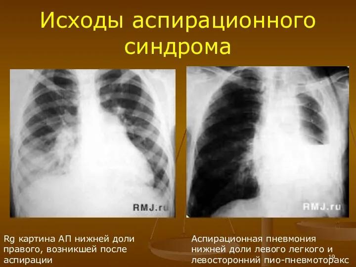 Rg картина АП нижней доли правого, возникшей после аспирации Исходы