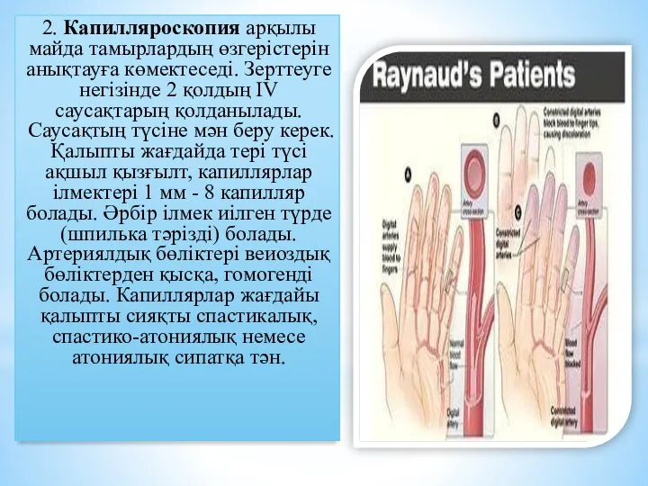 2. Капилляроскопия арқылы майда тамырлардың өзгерістерін анықтауға көмектеседі. Зерттеуге негізінде