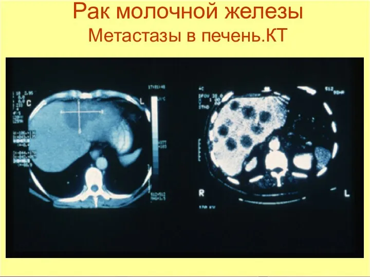 Рак молочной железы Метастазы в печень.КТ
