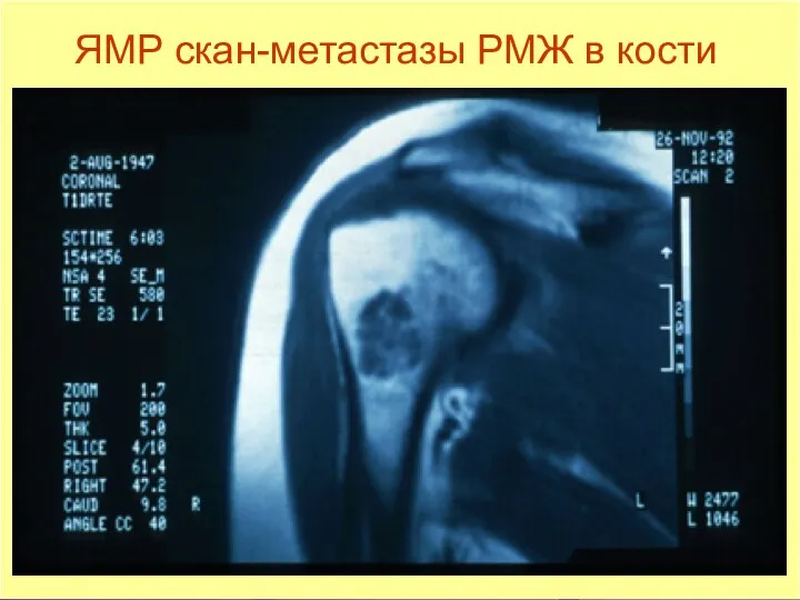 ЯМР скан-метастазы РМЖ в кости