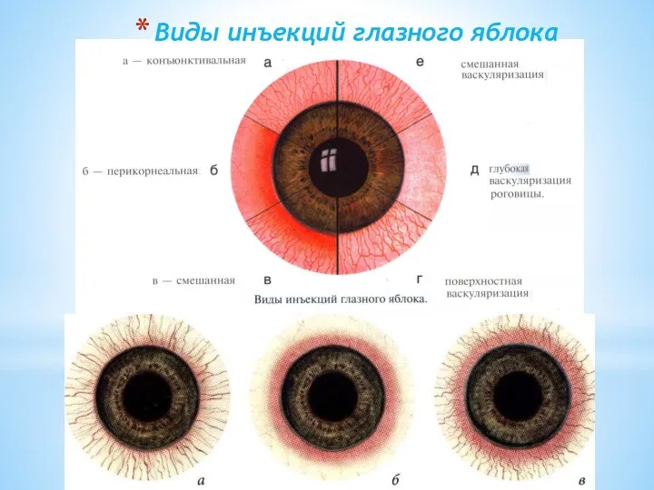 Виды инъекций глазного яблока