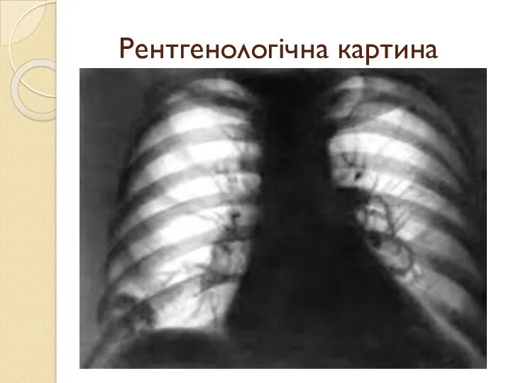 Рентгенологічна картина