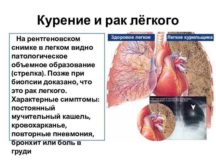 Курение и рак лёгкого На рентгеновском снимке в легком видно патологическое объемное образование