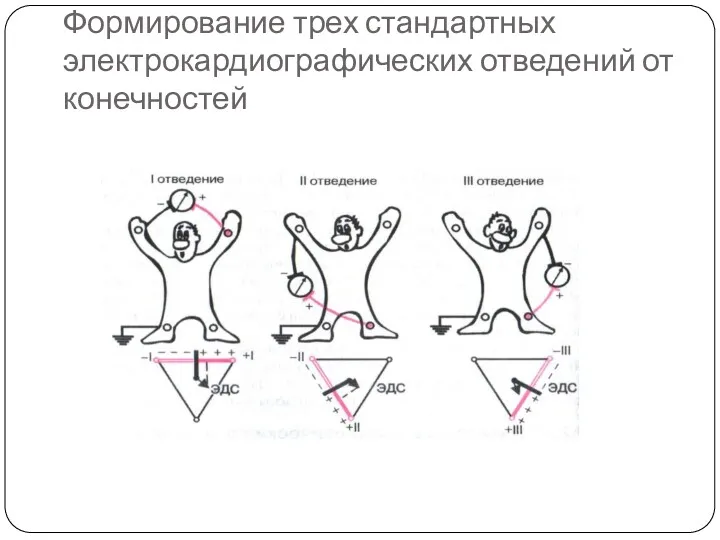 Формирование трех стандартных электрокардиографических отведений от конечностей