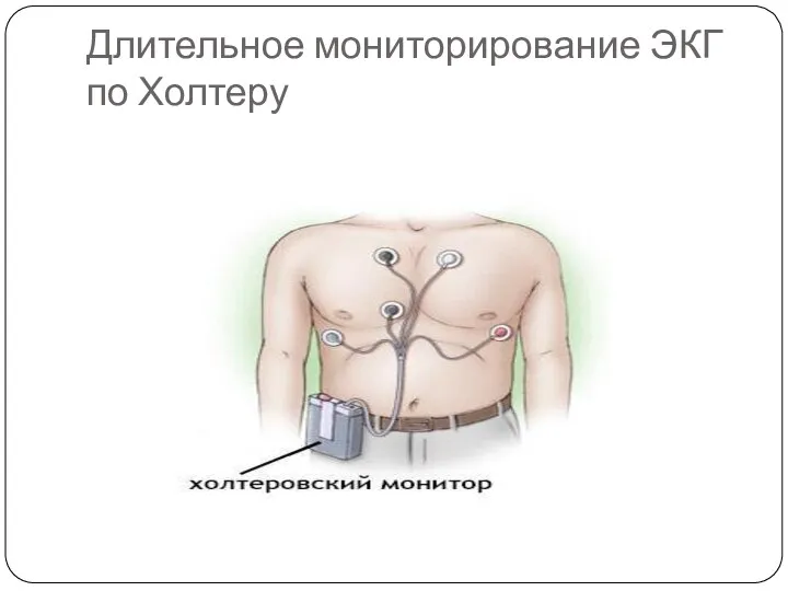 Длительное мониторирование ЭКГ по Холтеру