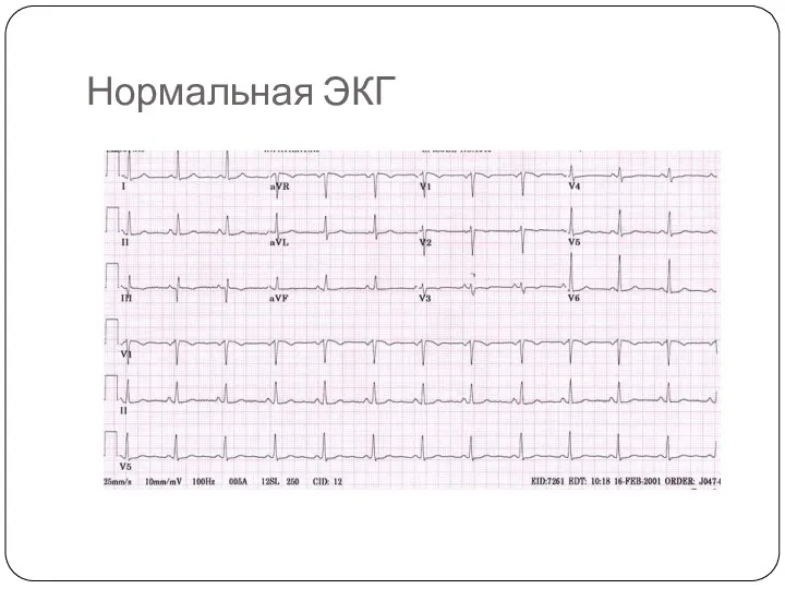 Нормальная ЭКГ