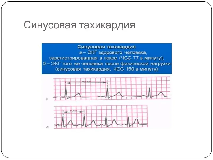 Синусовая тахикардия