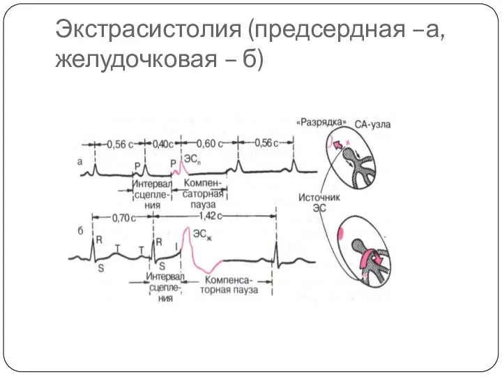 Экстрасистолия (предсердная –а, желудочковая – б)