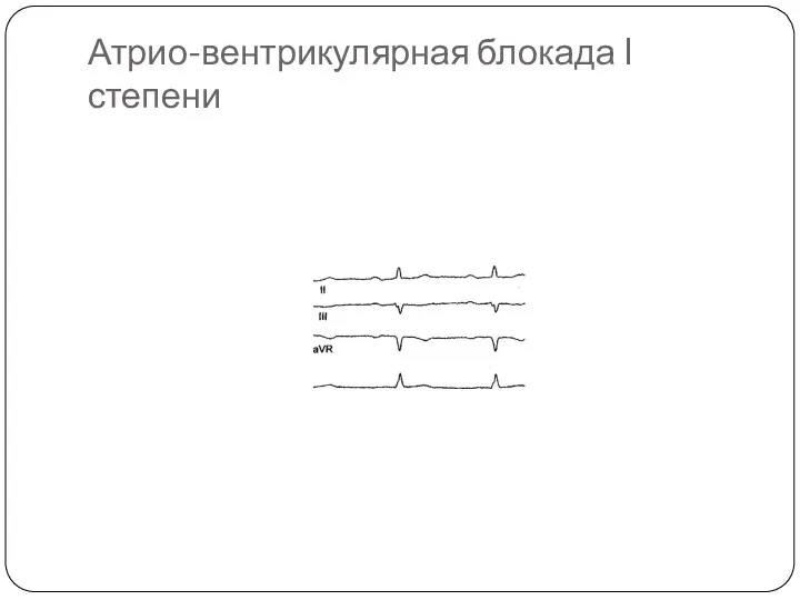 Атрио-вентрикулярная блокада I степени