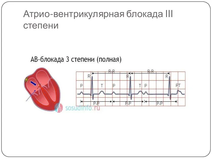 Атрио-вентрикулярная блокада III степени