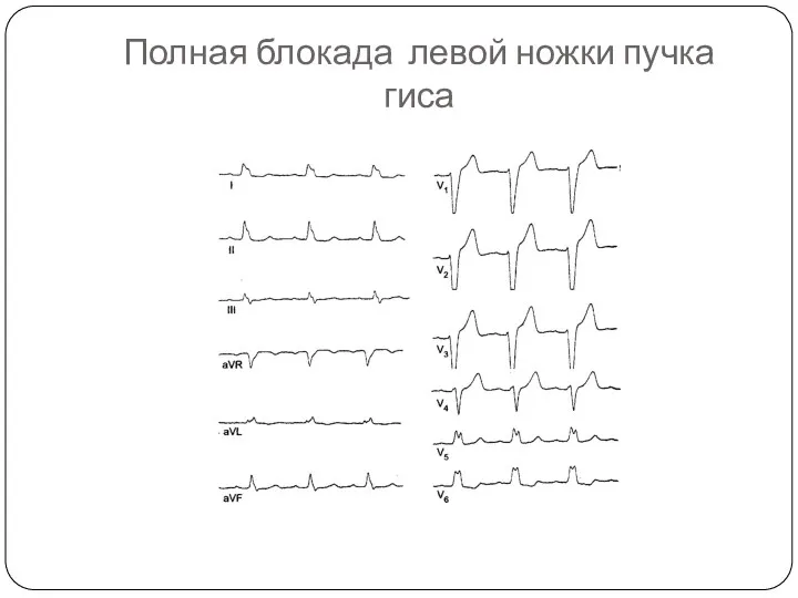 Полная блокада левой ножки пучка гиса