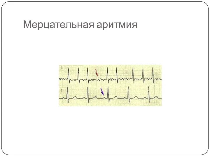 Мерцательная аритмия