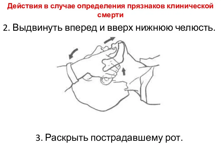 Действия в случае определения прязнаков клинической смерти 2. Выдвинуть вперед