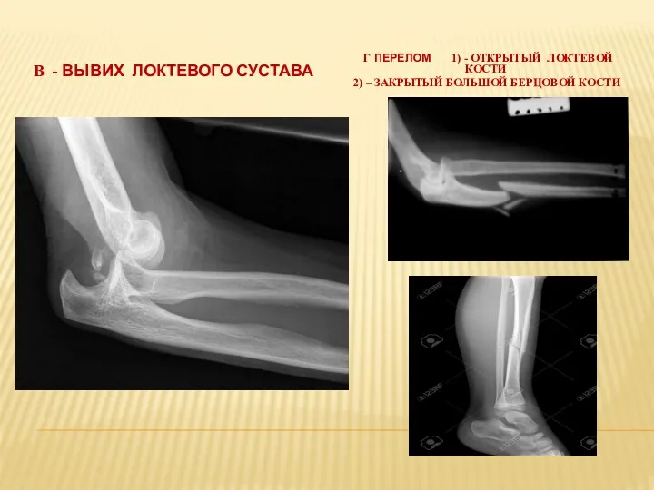 В - ВЫВИХ ЛОКТЕВОГО СУСТАВА Г ПЕРЕЛОМ 1) - ОТКРЫТЫЙ