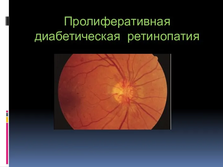 Пролиферативная диабетическая ретинопатия