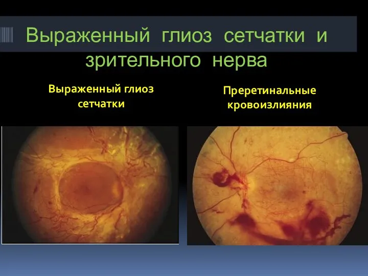 Выраженный глиоз сетчатки и зрительного нерва Выраженный глиоз сетчатки Преретинальные кровоизлияния