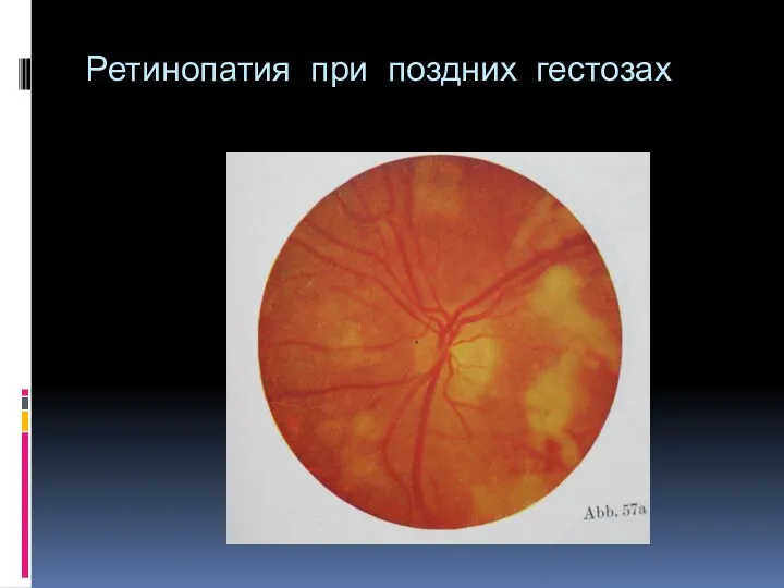 Ретинопатия при поздних гестозах