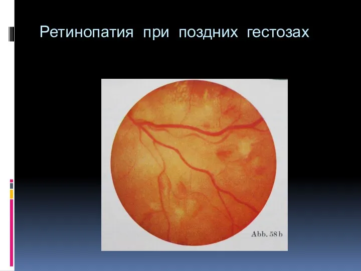 Ретинопатия при поздних гестозах