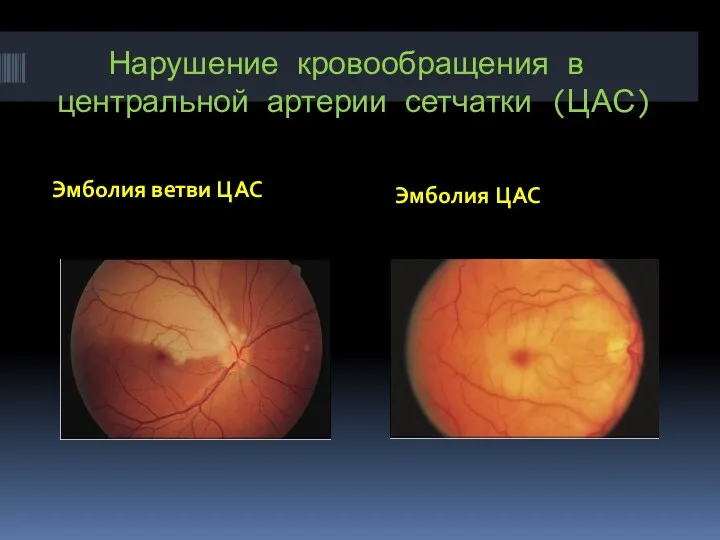 Нарушение кровообращения в центральной артерии сетчатки (ЦАС) Эмболия ветви ЦАС Эмболия ЦАС