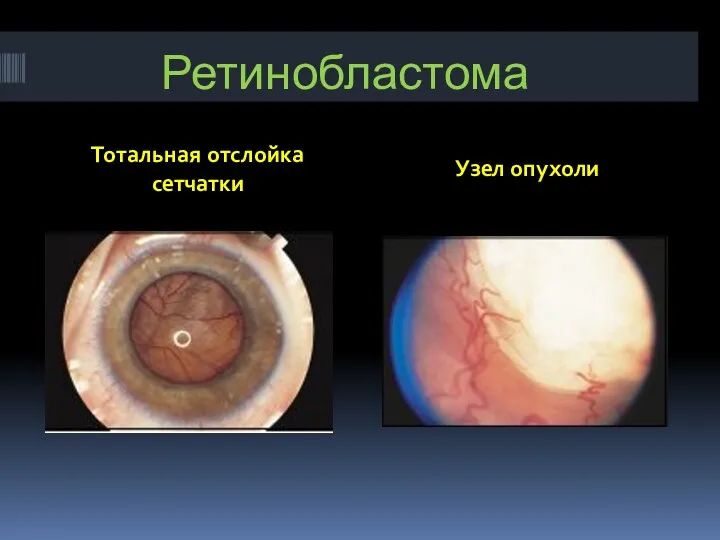 Ретинобластома Тотальная отслойка сетчатки Узел опухоли