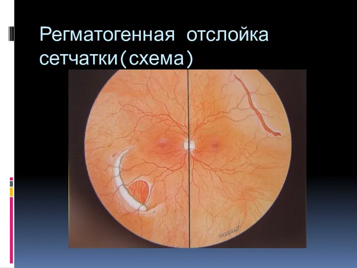 Регматогенная отслойка сетчатки(схема)