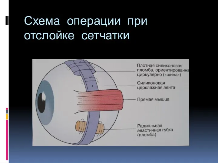 Схема операции при отслойке сетчатки