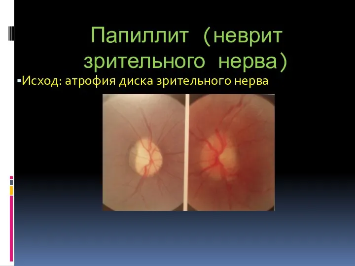 Папиллит (неврит зрительного нерва) Исход: атрофия диска зрительного нерва