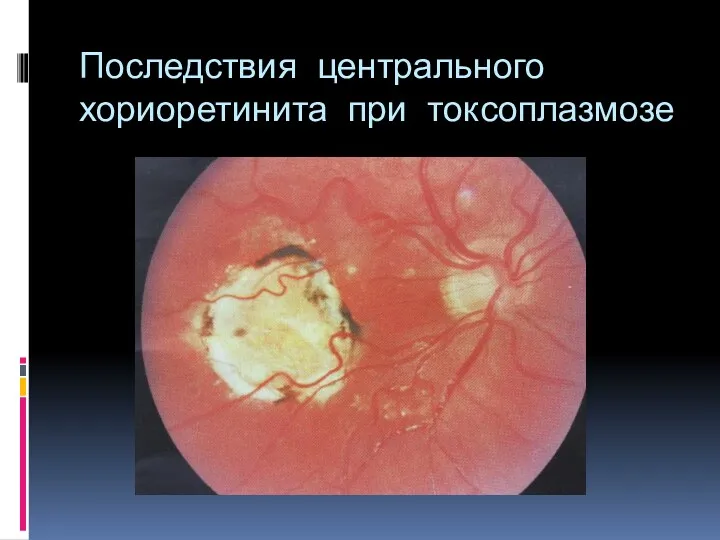 Последствия центрального хориоретинита при токсоплазмозе