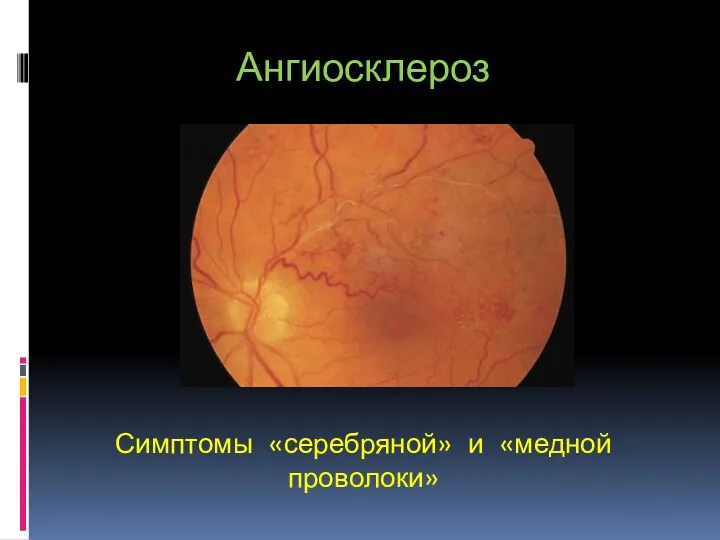 Ангиосклероз Симптомы «серебряной» и «медной проволоки»