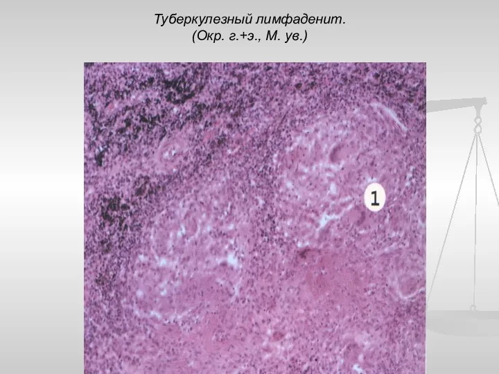 Туберкулезный лимфаденит. (Окр. г.+э., М. ув.)