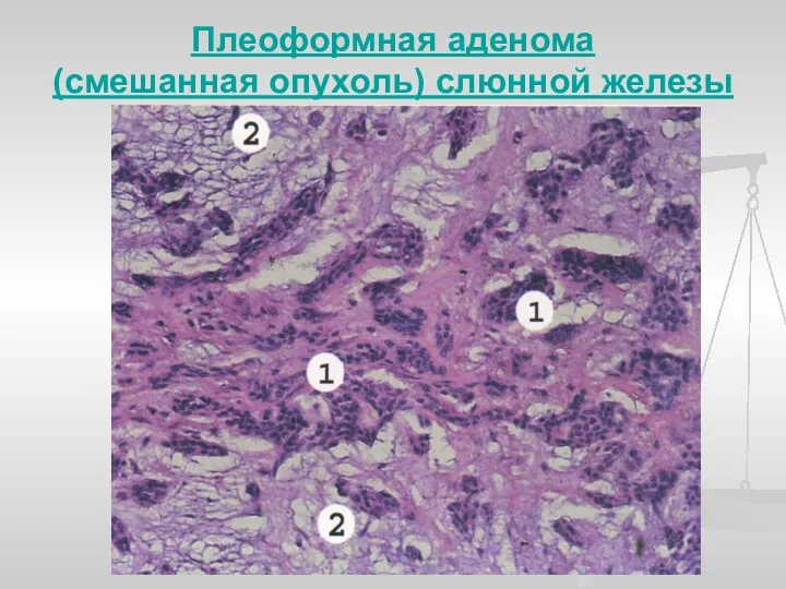 Плеоформная аденома (смешанная опухоль) слюнной железы .