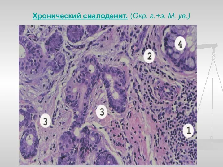 Хронический сиалоденит. (Окр. г.+э. М. ув.)