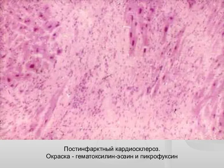 Постинфарктный кардиосклероз. Окраска - гематоксилин-эозин и пикрофуксин