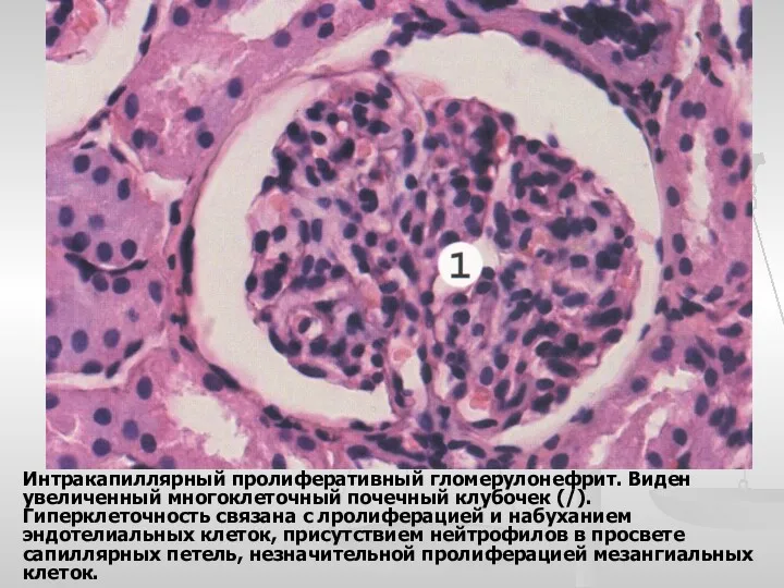 Интракапиллярный пролиферативный гломерулонефрит. Виден увеличенный многоклеточный почечный клубочек (/). Гиперклеточность связана с лролиферацией