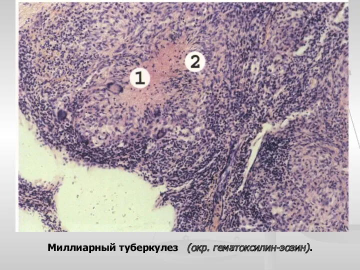 Миллиарный туберкулез (окр. гематоксилин-эозин).