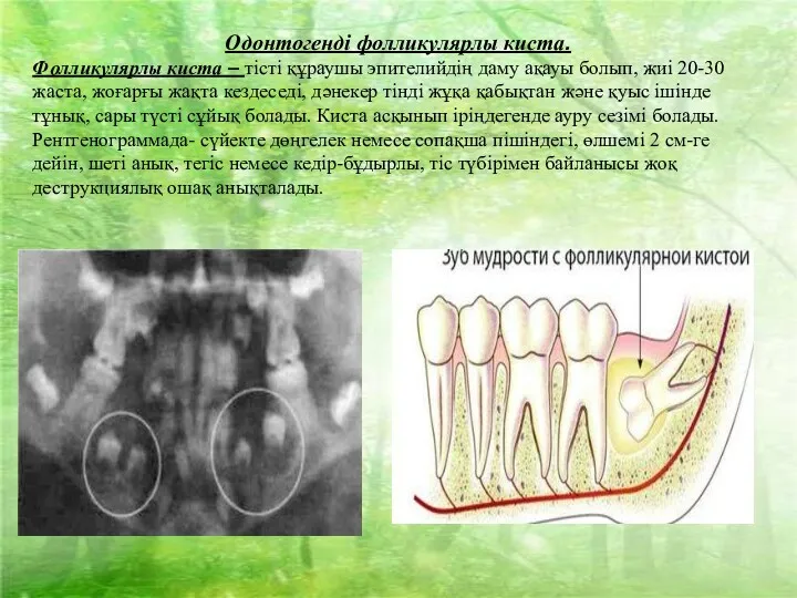 Одонтогенді фолликулярлы киста. Фолликулярлы киста – тісті құраушы эпителийдің даму