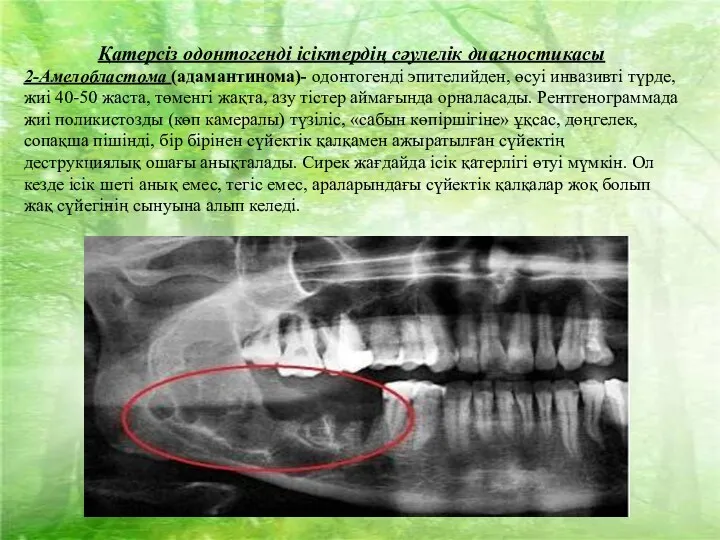 Қатерсіз одонтогенді ісіктердің сәулелік диагностикасы 2-Амелобластома (адамантинома)- одонтогенді эпителийден, өсуі