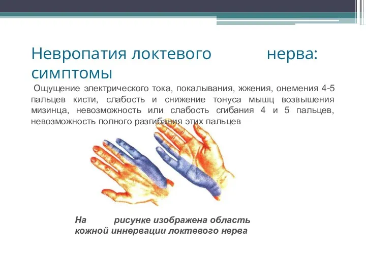 Невропатия локтевого нерва: симптомы Ощущение электрического тока, покалывания, жжения, онемения