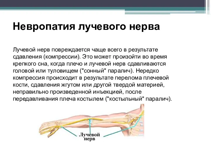 Невропатия лучевого нерва Лучевой нерв повреждается чаще всего в результате