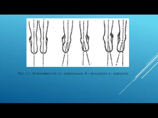 Рис. 1.1. Установка п’ят: а – нормальна, б – вальгусна, в – варусна.