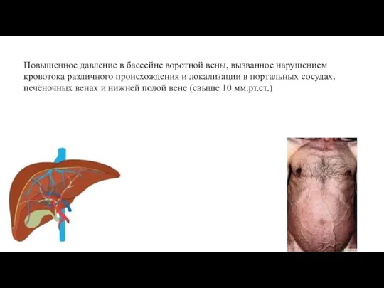 Портальная гипертензия (ПГ) Повышенное давление в бассейне воротной вены, вызванное