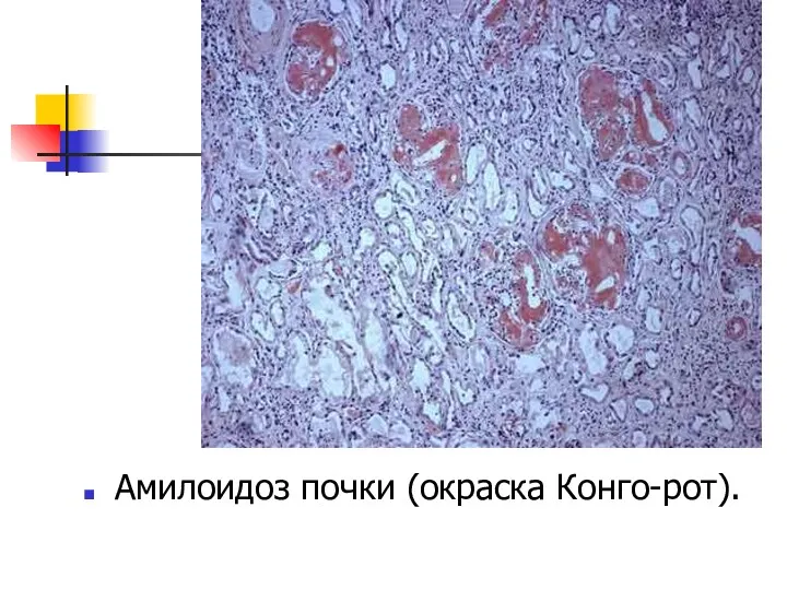 Амилоидоз почки (окраска Конго-рот).