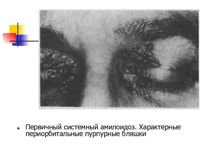 Первичный системный амилоидоз. Характерные периорбитальные пурпурные бляшки