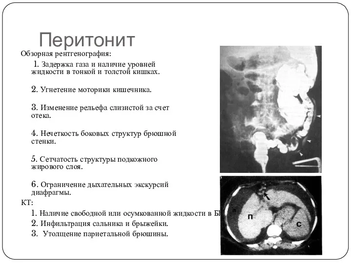 Перитонит Обзорная рентгенография: 1. Задержка газа и наличие уровней жидкости