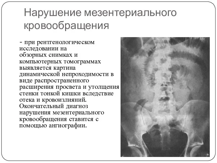 Нарушение мезентериального кровообращения - при рентгенологическом исследовании на обзорных снимках