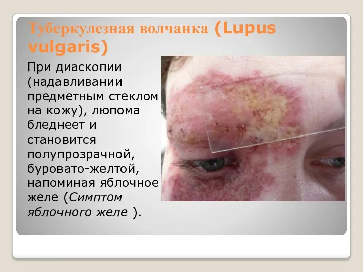 Туберкулезная волчанка (Lupus vulgaris) При диаскопии (надавливании предметным стеклом на кожу), люпома бледнеет