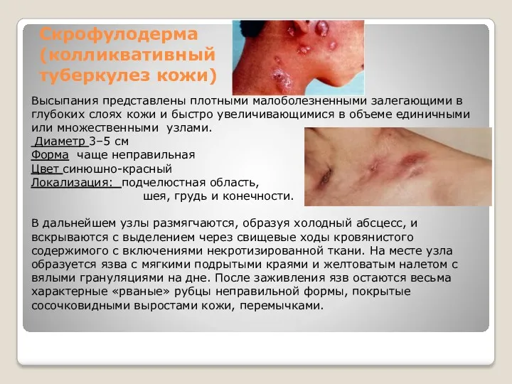 Скрофулодерма (колликвативный туберкулез кожи) Высыпания представлены плотными малоболезненными залегающими в глубоких слоях кожи