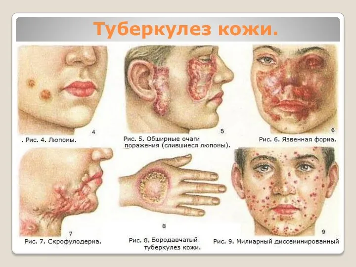 Туберкулез кожи.